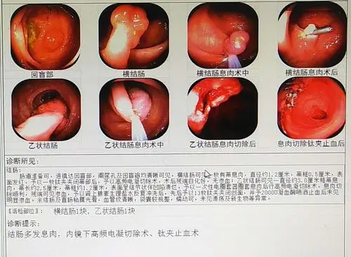 肠镜检查不用怕