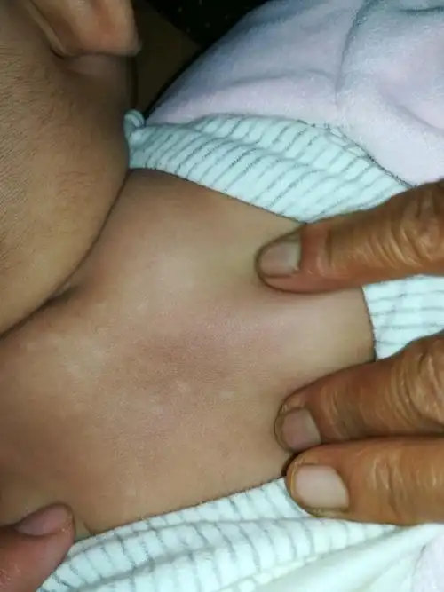 宝宝背上起小白点