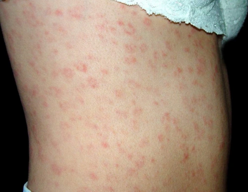 梅毒前期小红点图片 (13)