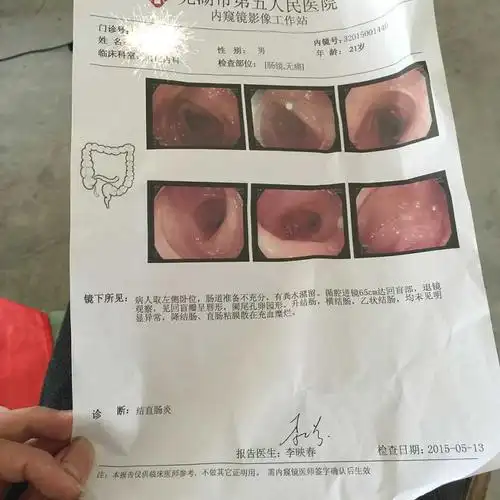 正常直肠镜图片 (第2页)