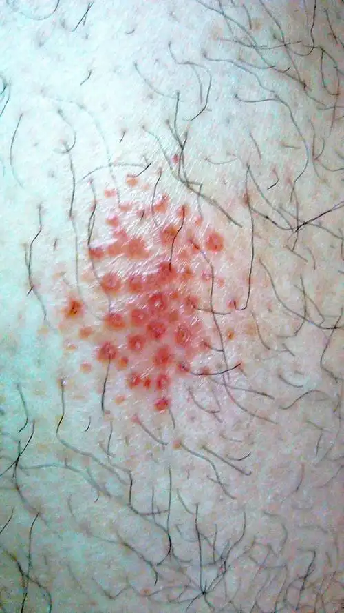 腿部皮肤起红疹,求帮助,有照片