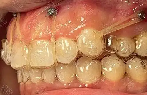 网上透明牙套真的可以矫正吗千万不要轻易尝试
