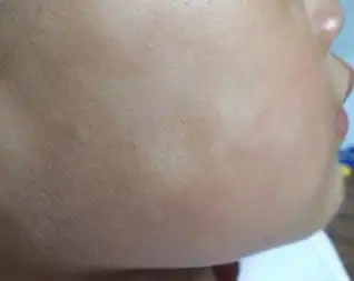 白色糠疹小知识