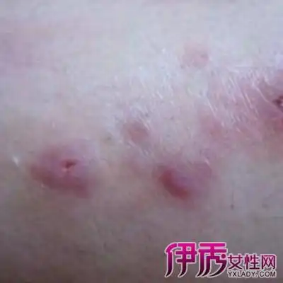 【图】女性性病的症状图片 了解四大临床表现