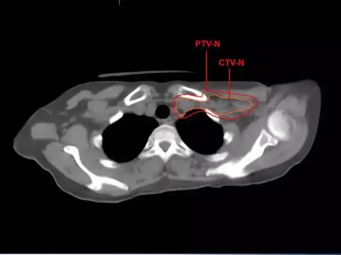 乳腺癌精准放疗靶区勾画图谱