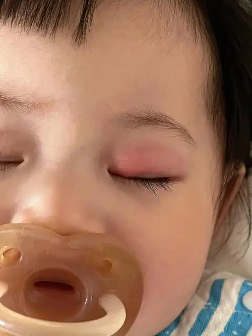 宝宝也会长眼疮宝宝上火清热解毒