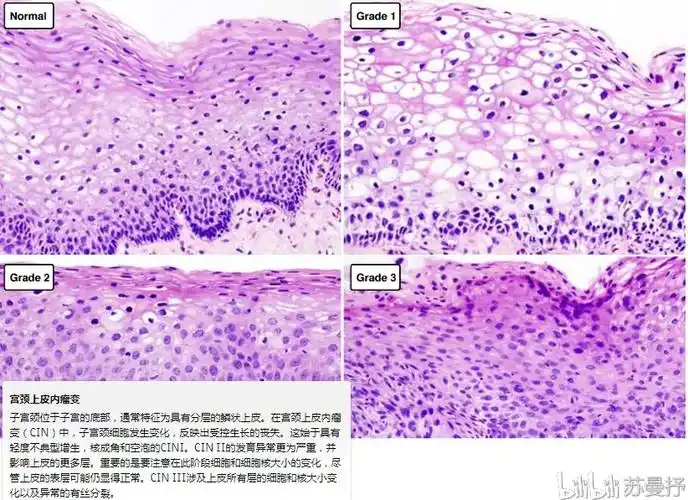 见谅~ 病理切片 香烟烟雾引起的刺激已显示会导致鳞状上皮化生,其中
