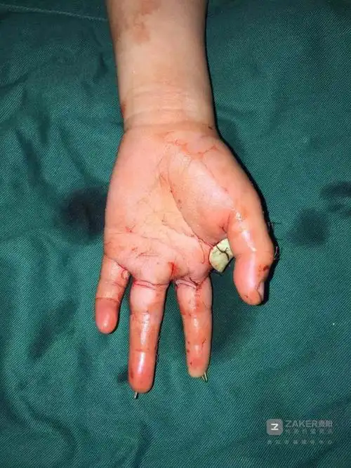 6 岁孩子左手卷进割猪草机 两根手指当场被绞断