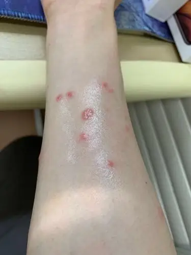 猫猫和人得了猫癣怎么办?跪求,急