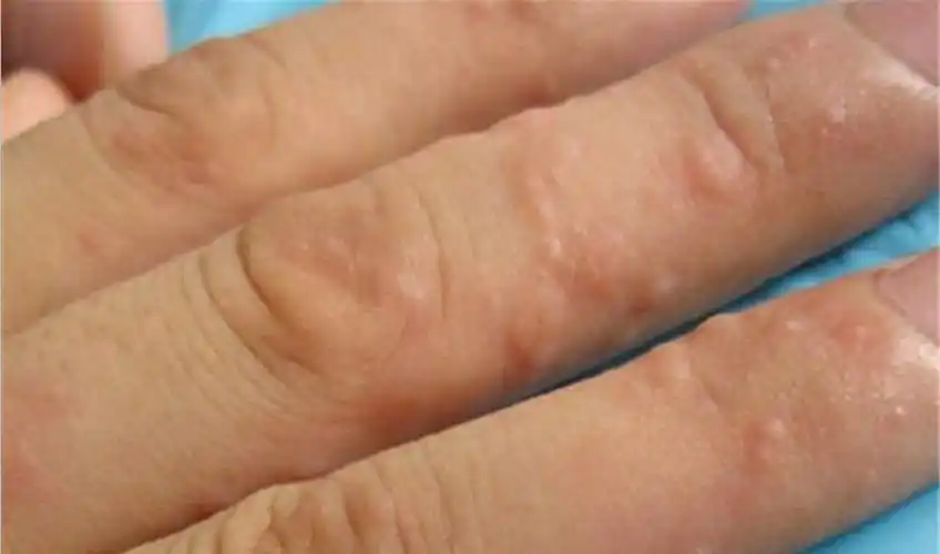 天津手癣专家_天津治疗手癣哪个专家好_天津治疗手癣最好的专家/排行