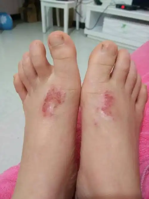 怀孕了,没怀孕之前脚上就有湿疹,现在怀孕一个半月,又不敢用药,脚上