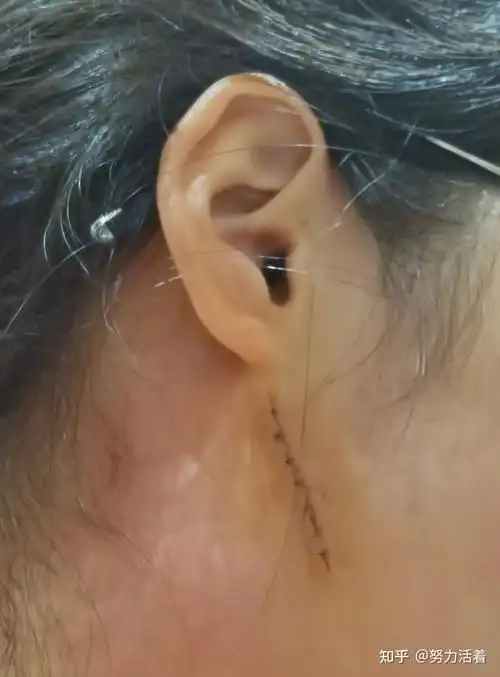 黑毛痣切除以及后期护理记录