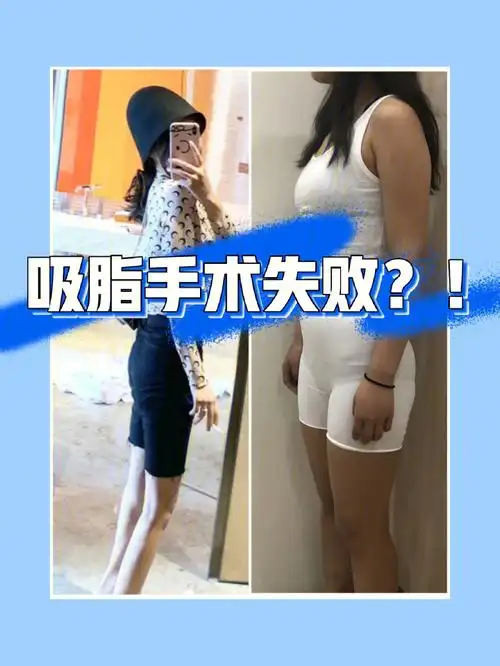 吸脂手术失败了??!