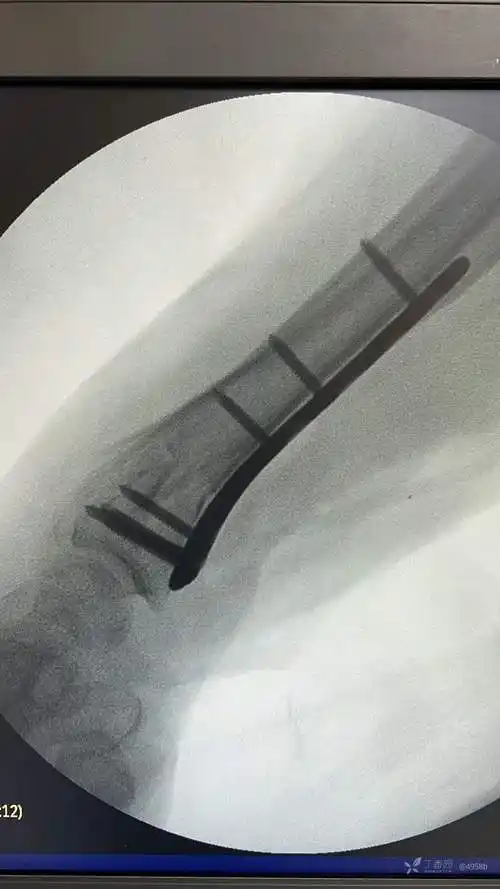 一例桡尺骨远端骨折内固定
