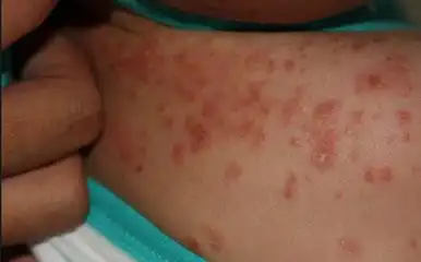 疥疮有什么伴随症状呢?_邯郸燕赵中医皮肤病医院