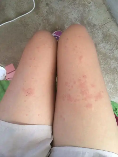 身上起的小疙瘩 一片片的 谁知道是什么