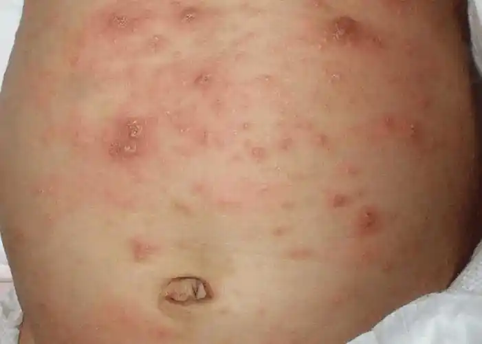 5,夜间加重:疥疮的症状通常在晚上或在温热环境中加重,这是因为疥螨在