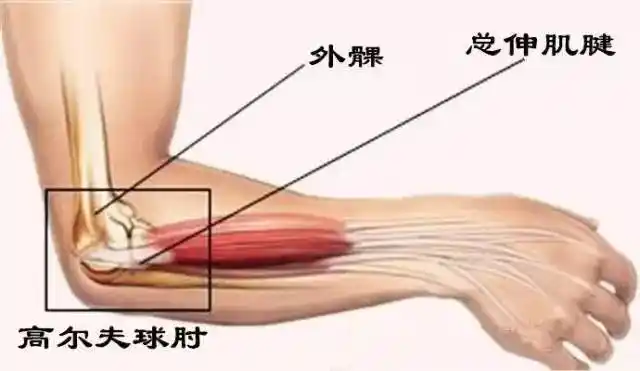 肌腱炎主要表现的肩关节囊及其周围韧带,肌腱和滑囊的慢性特异性炎症.