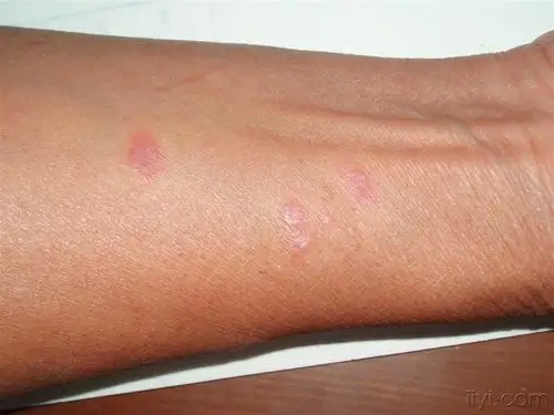 看看是什么病 扁平苔癣?