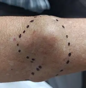 攻克三重关九院普外二科助耄耋老人斩落手臂肉瘤