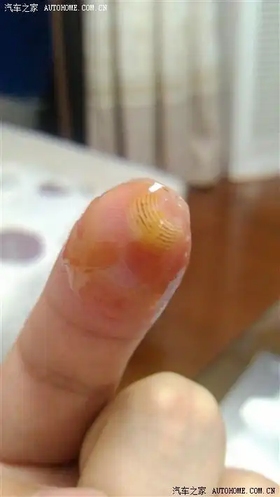 悲催—————手指头被点烟器烫的冒烟