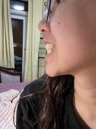 我这样的嘴凸是不是算骨性的呀… 有必要去二次正畸吗