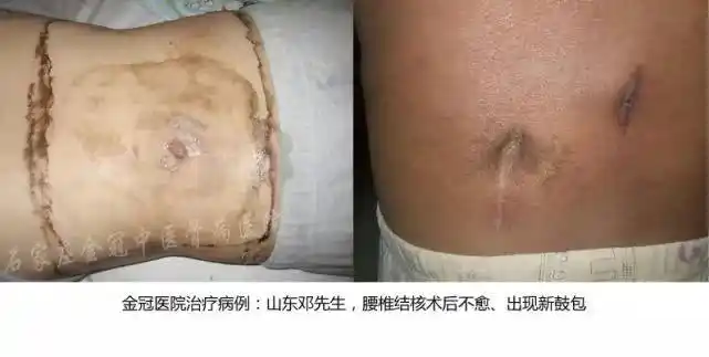 骨结核怎么治疗可以快速恢复正常生活?轻症患者只需3个月