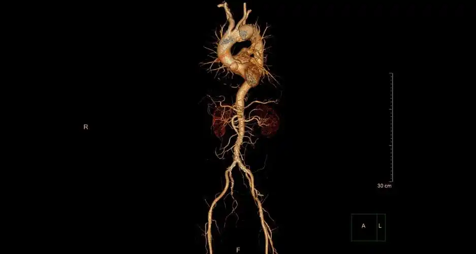 (内有手术图片,请慎入)_胸主动脉瘤_介绍_治疗方式 - 好大夫在线