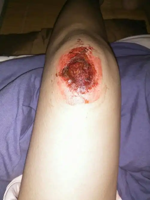 膝盖摔伤好像在结痂了,有灼热感,有点痛正常吗,伤口表面已经干燥了