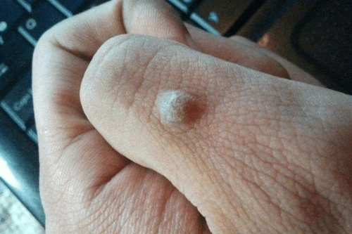 用这种黑色的果子外敷就可以治好瘊子