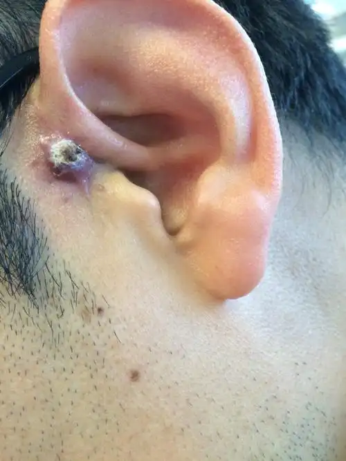 耳前瘘管第二次手术