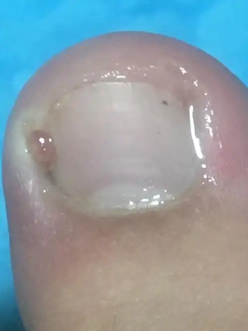 甲沟炎应该怎么治啊?