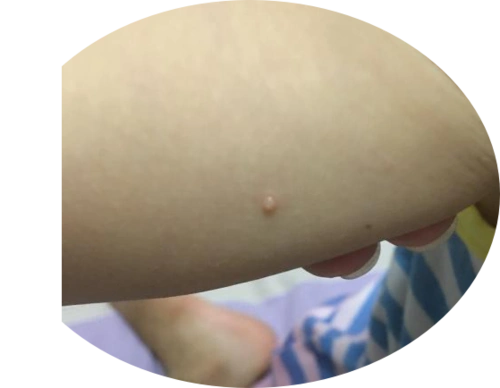 传染性软疣俗称"水猴子",是由传染性软疣病毒感染所致的传染性皮肤病.