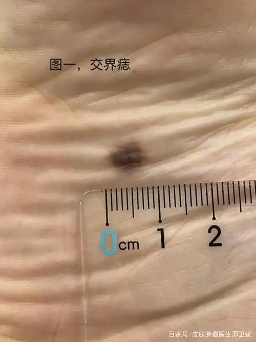 一般来说交界痣相对容易恶变,皮内痣恶变几率很小.