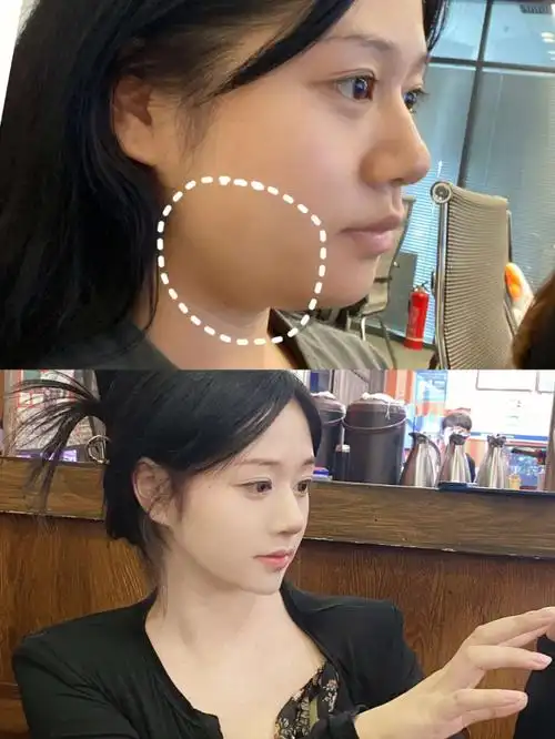 2022年了你还不会用这个方法瘦下颚线吗