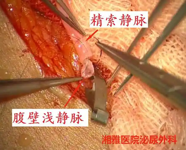 泌尿外科手显微外科省内率先开展显微转流术治疗精索静脉曲张