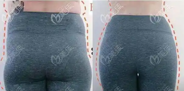 提高,假胯的地方重点处理,主要是对臀部和腰部两侧突出的肉进行吸脂