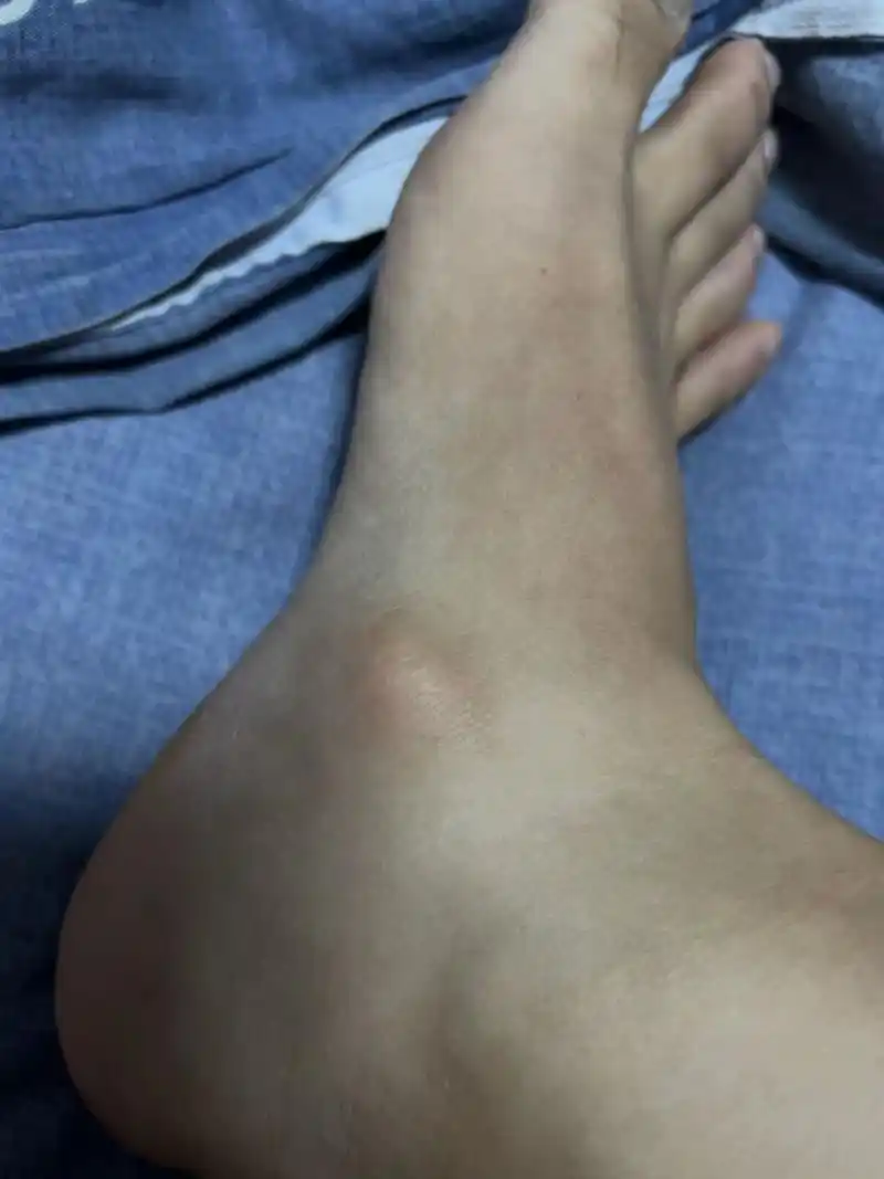 足副舟骨突出 但是不疼 小时候胖总崴脚挺严重 现在也没感觉 就是突出