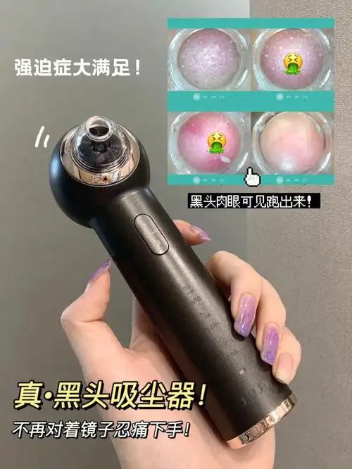 强迫症大满足黑头就这样没了