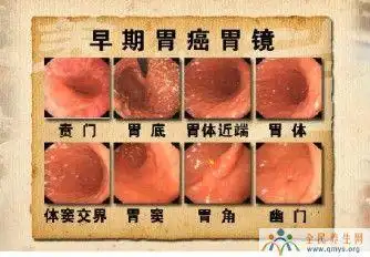 胃癌的早期症状有哪些胃病的症状表现有哪些