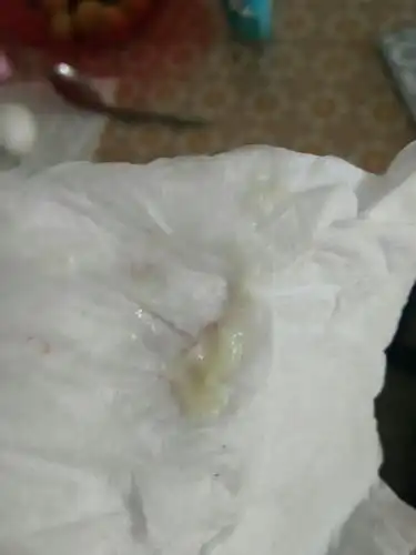 我36周这白带异常白色黏黏的