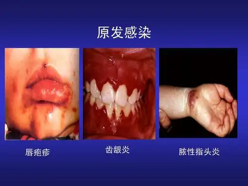 原发感染 唇疱疹 齿龈炎 脓性指头炎