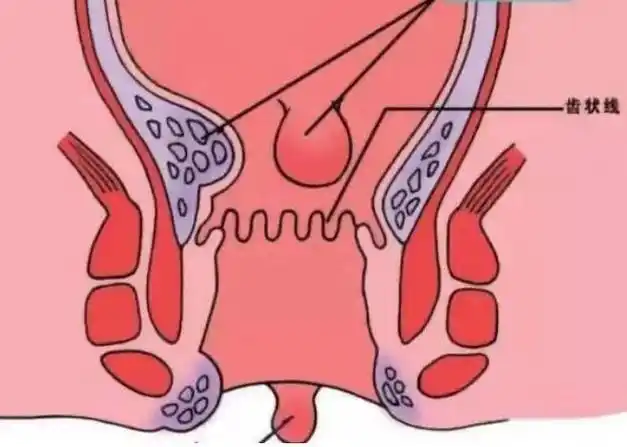 菊花虽小但也应保养痔疮应该怎么治如何摆脱有痔青年