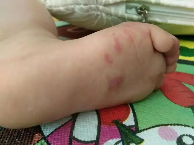 也是鲜红斑痣,血管瘤的一种,脚趾里面都有