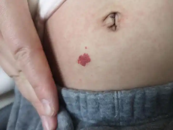 在各种"红胎记"中,毛细血管瘤属于真正起源于皮肤血管的良性肿瘤.