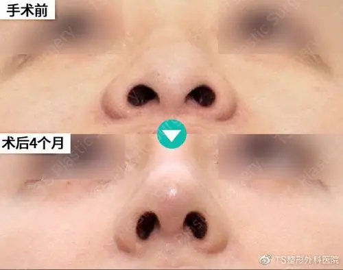 因又宽又大的鼻子而感到烦恼考虑做鼻翼缩小必须要注意的事项
