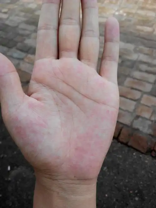 怀孕期间手心热,现在五个半月,手怎么这样啦