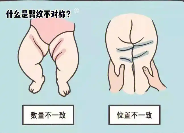宝宝臀纹不对称可要警惕了