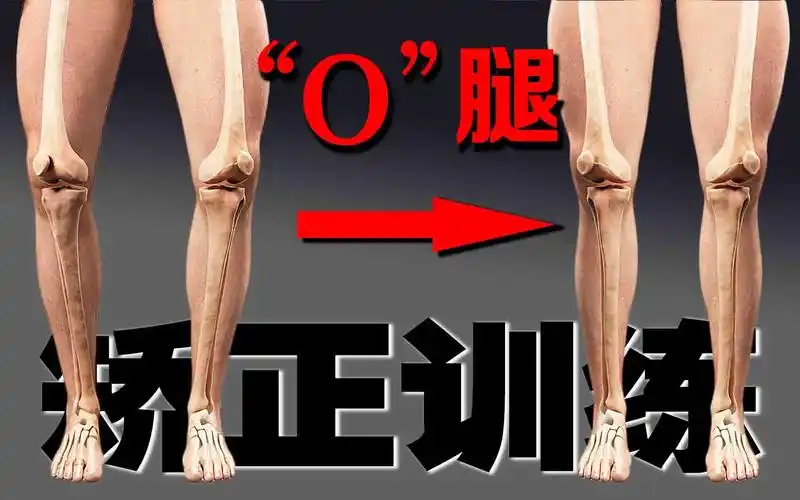 如何矫正罗圈腿o型腿教大家一套简单有效的训练家里就可完成