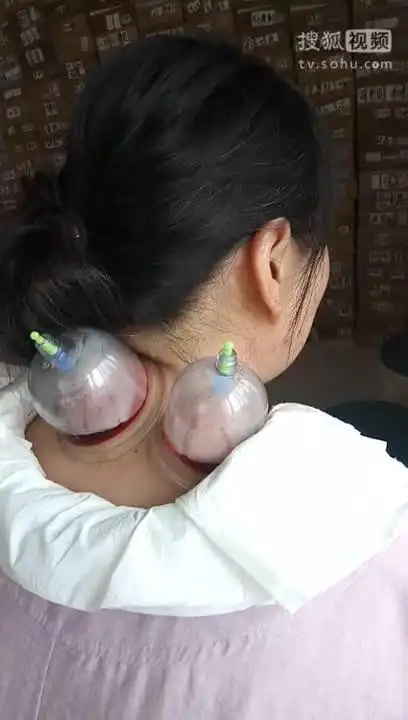 河南康健排瘀疗法 颈椎病调理 偏头痛 头晕 失眠 拔罐泄血 刺络放血